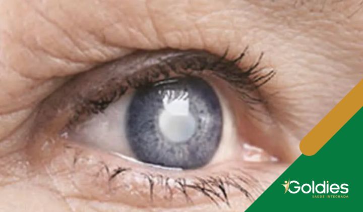 Close de um olho azul com catarata visível, ilustrando o post "Catarata: um guia rápido sobre a doença"