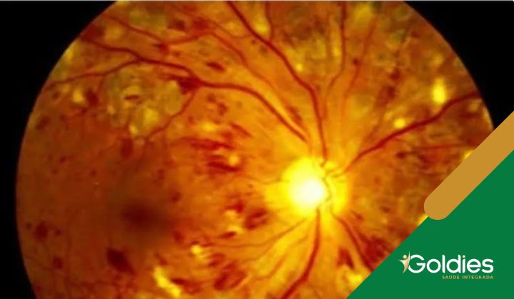 Imagem de close-up de uma retina humana, mostrando veias e um disco óptico brilhante, ilustrando o post "Retinopatia Diabética: entenda mais sobre a doença"