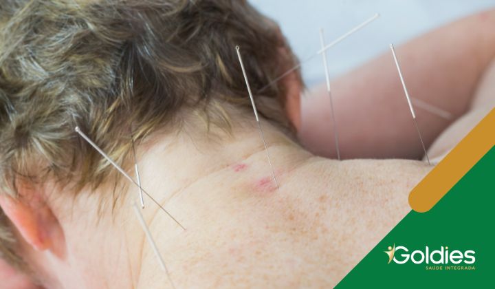 Close do pescoço e ombro de uma pessoa com várias agulhas de acupuntura inseridas na pele, ilustrando o post "Acupuntura para idosos"