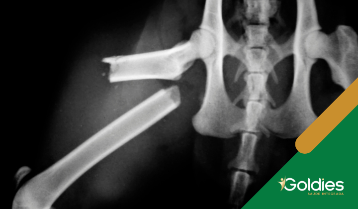 Radiografia de fêmur exibindo uma fratura, ilustrando o post "Fratura do fêmur em seniores: cuidados necessários"
