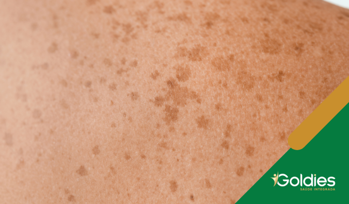 Imagem de pele representando a postagem "Câncer de Pele Não Melanoma: Prevenção, Sintomas e Tratamentos Eficazes"